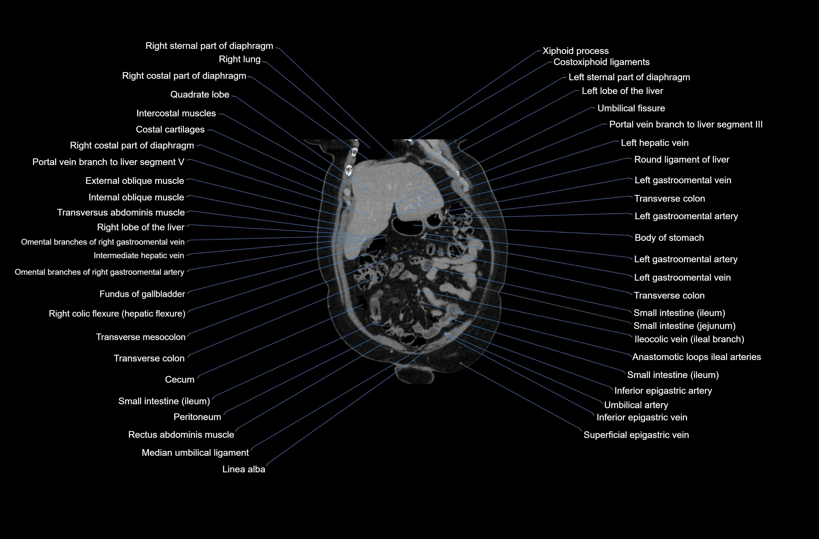 CT abdomen coronal cross sectional anatomy labelled radiology image-00018.webp